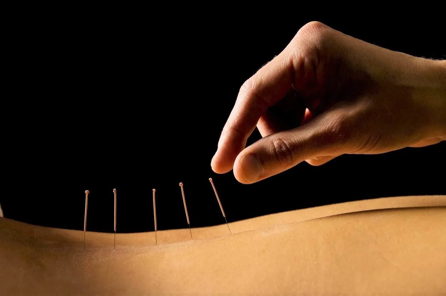 A person is using acupuncture needles to treat an illness.